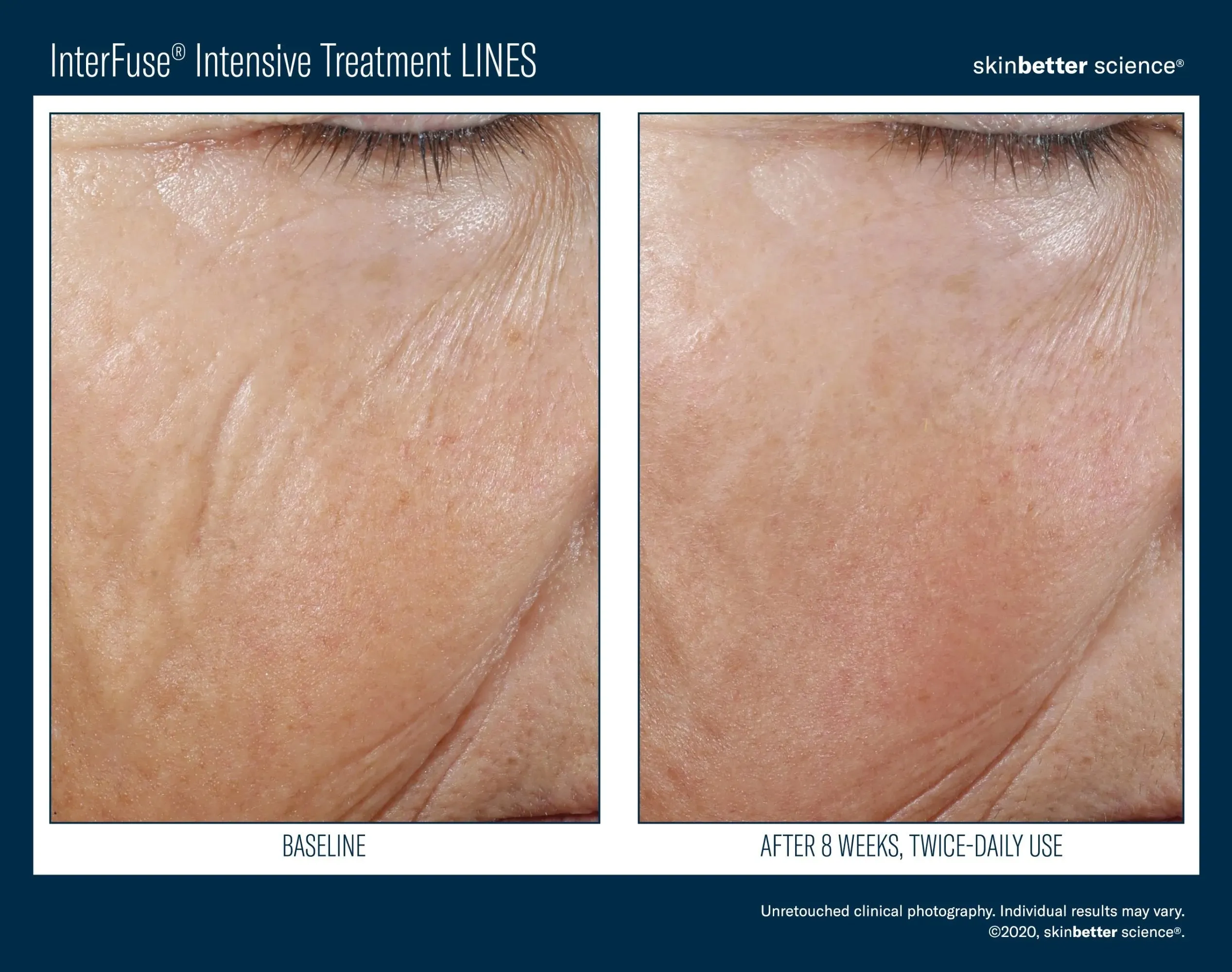 InterFuse Intensive Treatment LINES